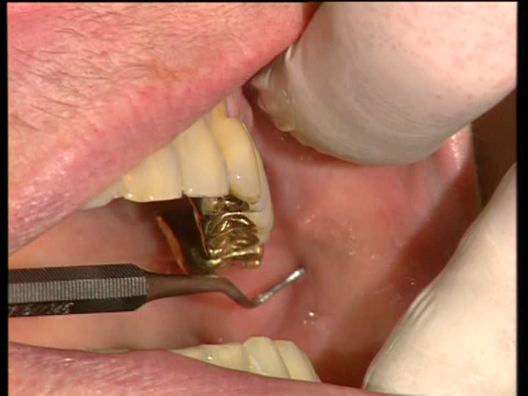 Mundakupunktur-Palpation-Mandibel-Tubermaxille