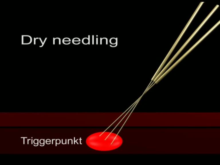 dry-needling-technik