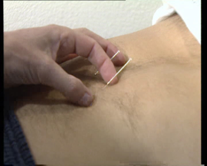 akupunkturpunkt magen18 