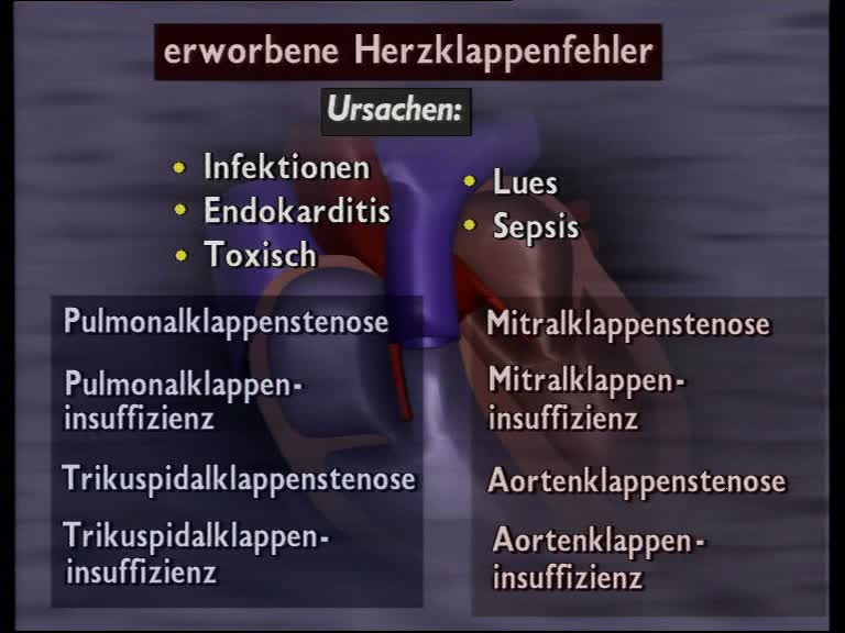 Die Herzklappenfehler, Mitralstenose, Mitralinsuffizienz ...