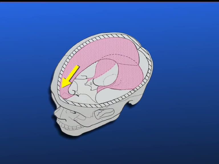 prain radiation of the cranial dura mater