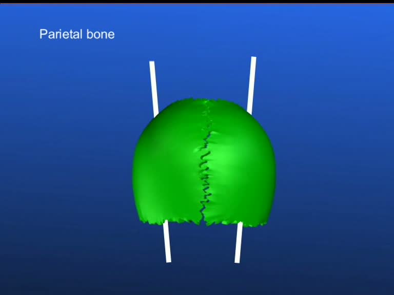 parietal bone sagittal suture lateral rims 