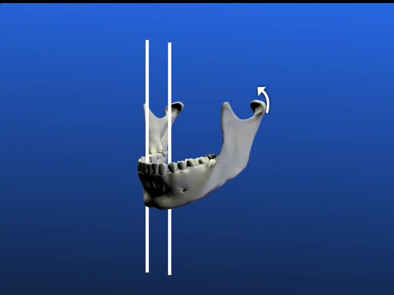 mandible condylar processus move posterior medial