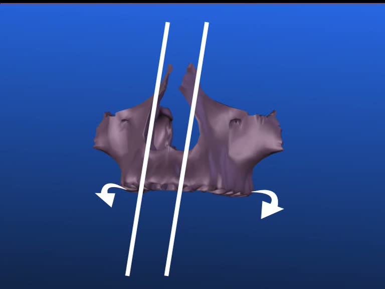 maxilla alveolar processus palate plate sinks