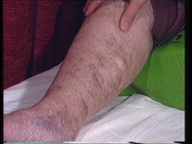 postthrombotisches syndrom