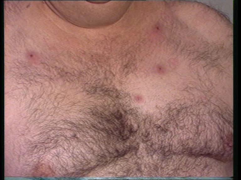 blutegel angina pectoris