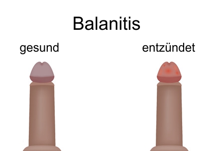 Entzündung bartholinische drüse Bartholinitis: Diese