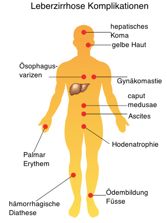 leberzirrhose komplikationen