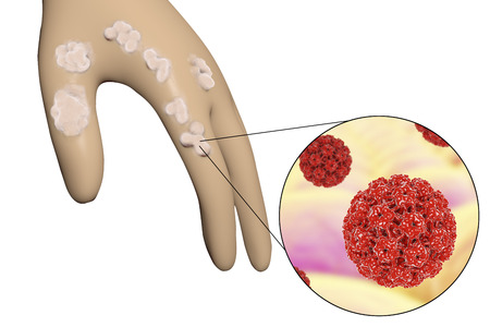 Genitalwarzen auf der Haut