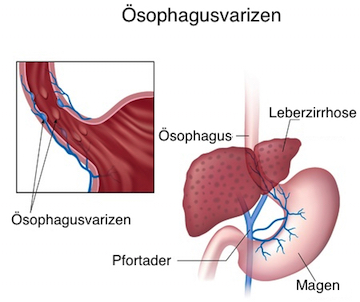 ösophagusvarizen