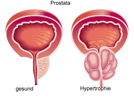 prostataadenom symptome
