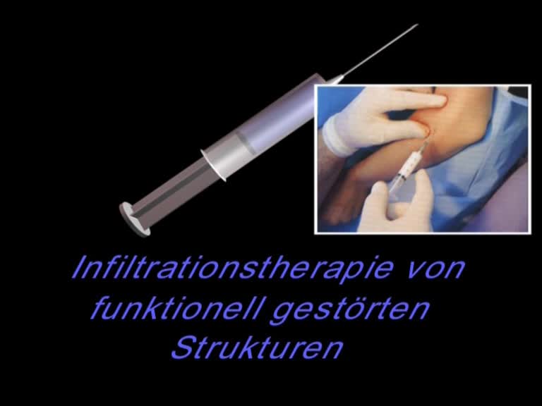 infiltrationstherapie
