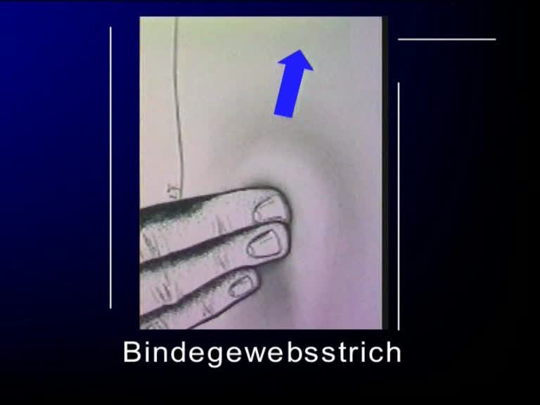 bindegewebsstrich