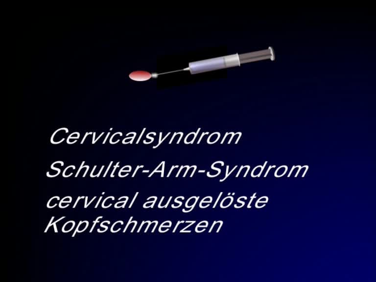 cervicalsyndrom-
