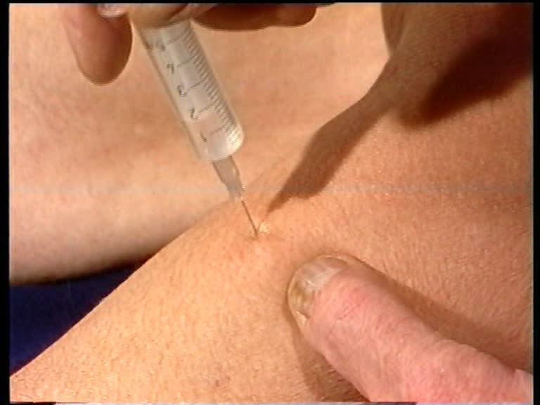ellenbogengelenk infiltration